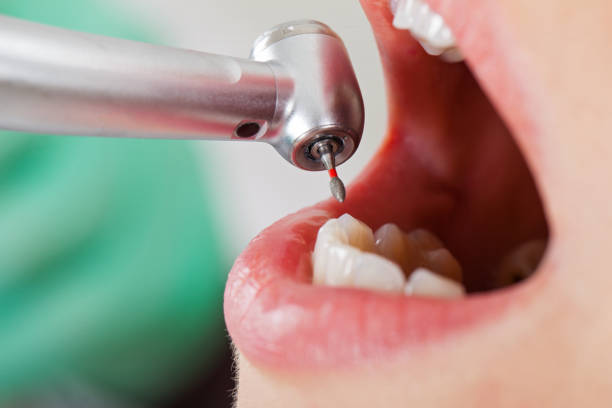 Best Dental Abscess Treatment in High Bridge, NJ